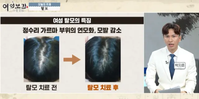 압구정 뷰리플한의원 여의보감 탈모 - 4