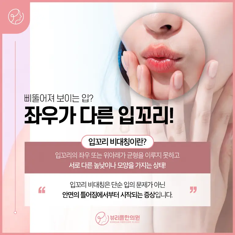 압구정 뷰리플한의원 입꼬리 비대칭