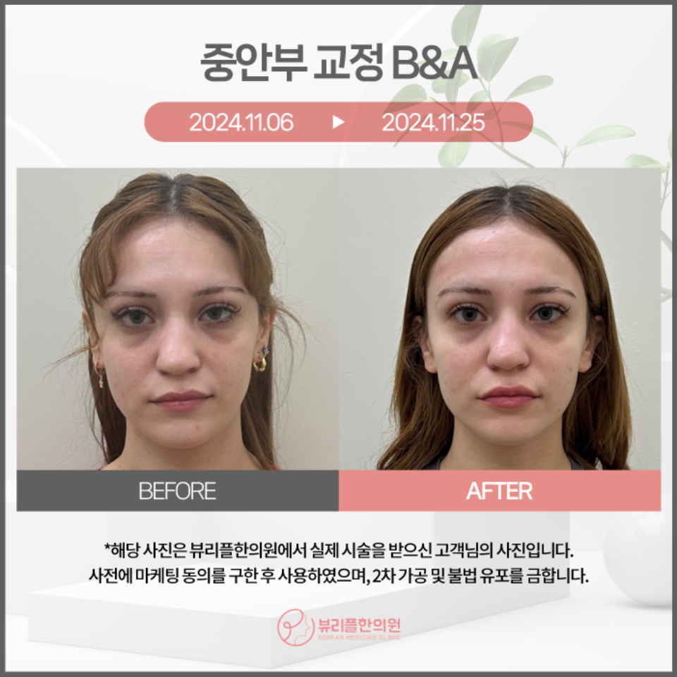 압구정 뷰리플한의원 중안부 교정 비포애프터