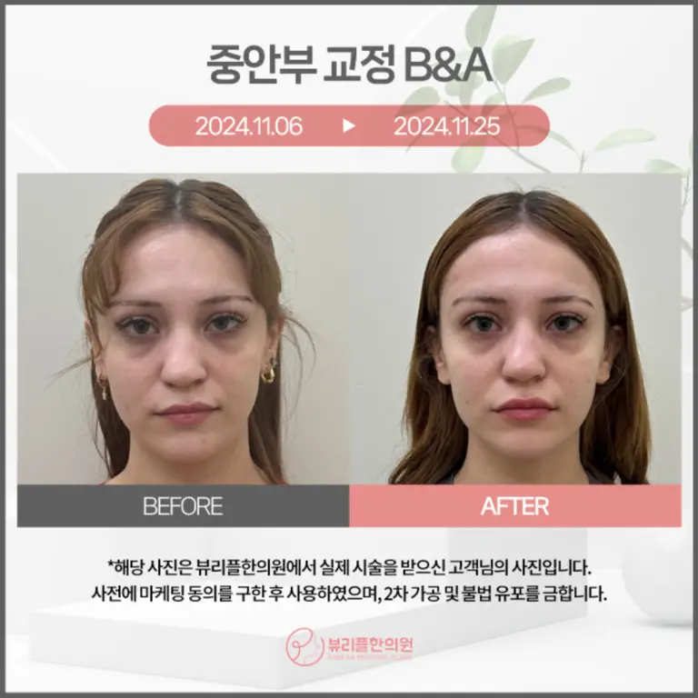 압구정 뷰리플한의원 중안부 교정 비포애프터