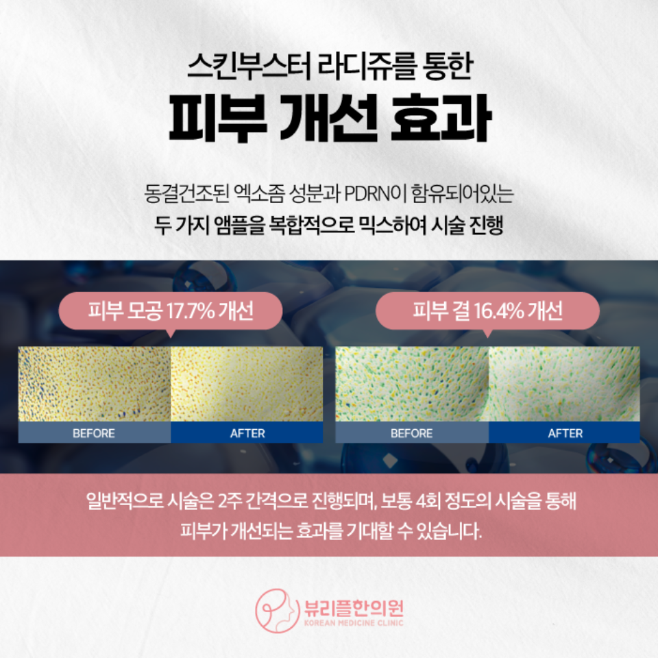 압구정 뷰리플한의원 스킨부스터 라디쥬 피부 개선 효과