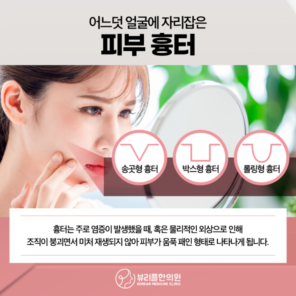 압구정 뷰리플한의원 여드름 피부 흉터