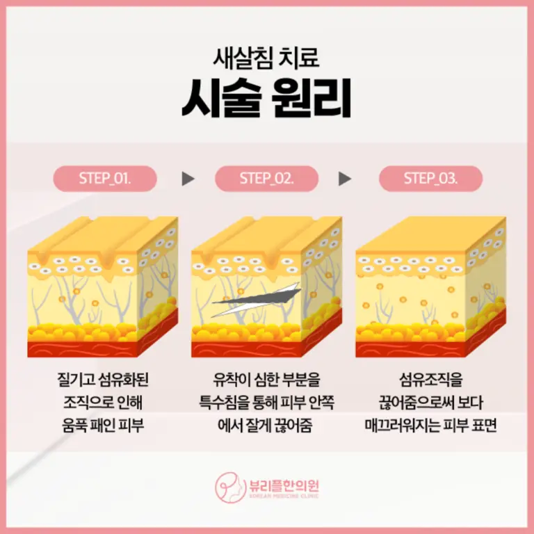 압구정 뷰리플한의원 새살침 치료 시술 원리