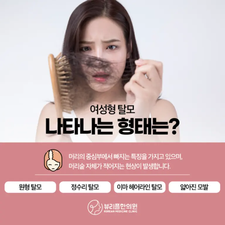 압구정 뷰리플한의원 여성형 탈모 형태
