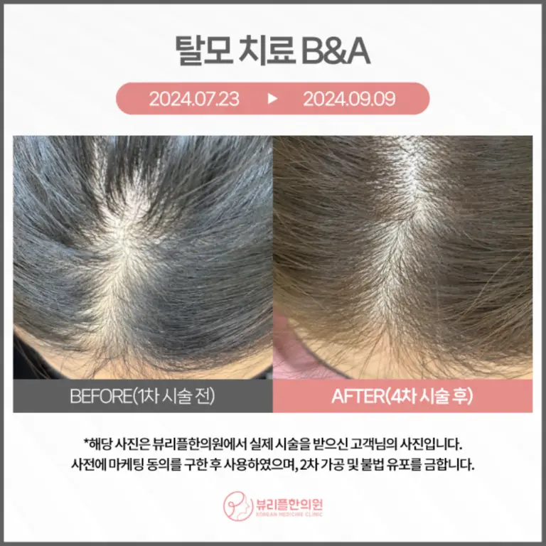 압구정 뷰리플한의원 탈모 치료 비포애프터