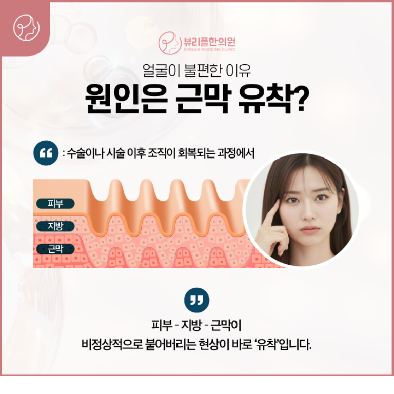 압구정 뷰리플한의원 원인은 근막 유착