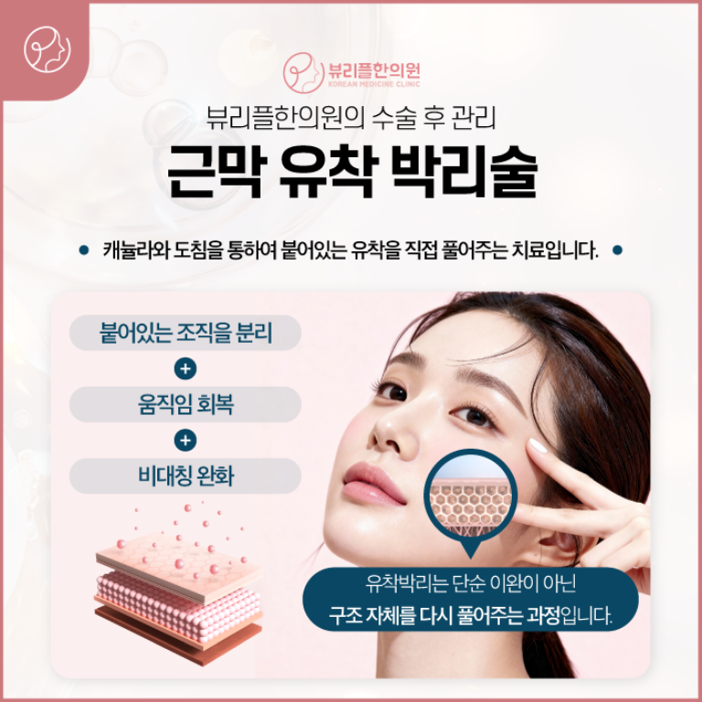 압구정 뷰리플한의원 근막 유착 박리술