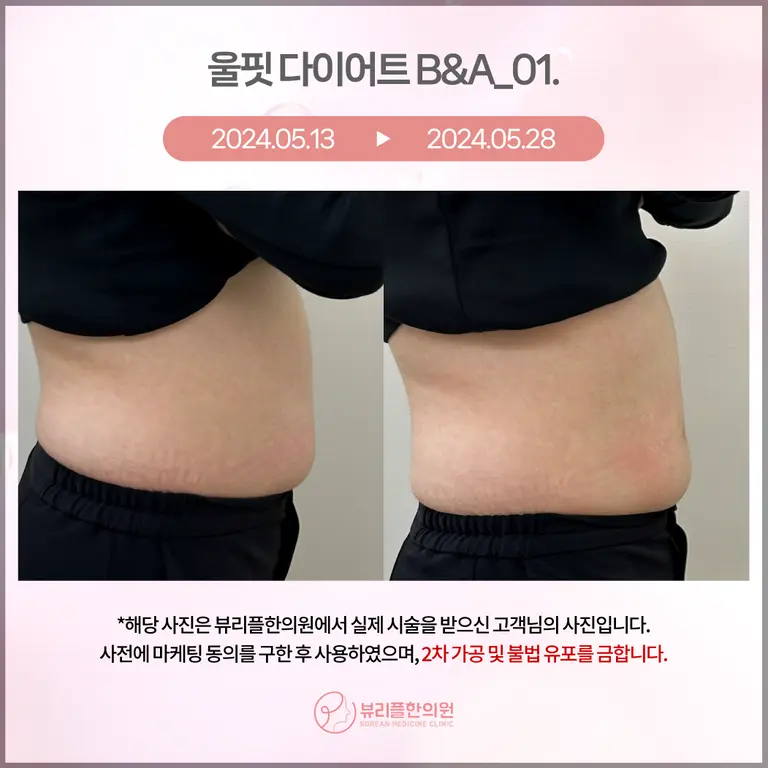 압구정 뷰리플한의원 울핏 다이어트 비포애프터 - 1