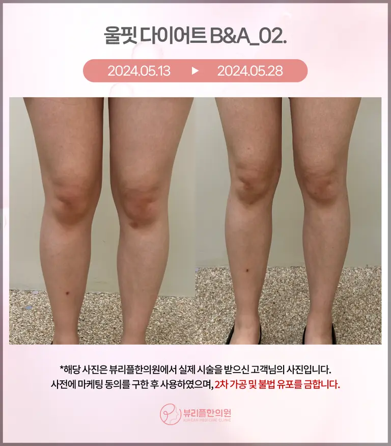 압구정 뷰리플한의원 울핏 다이어트 비포애프터 - 2